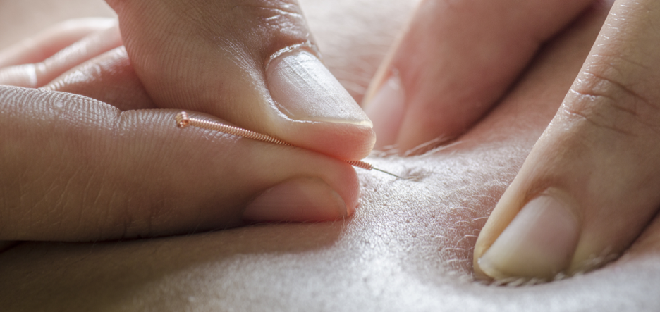 Dry-needlingbehandeling